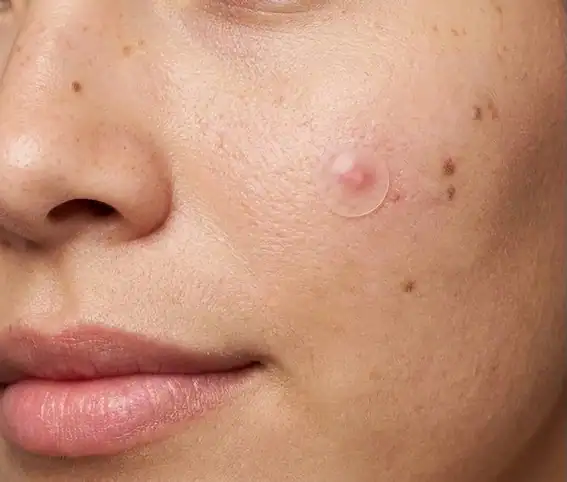 Macro photo of cheek skin with one surfaced pustule and visible pores, illustrating do pimple patches work