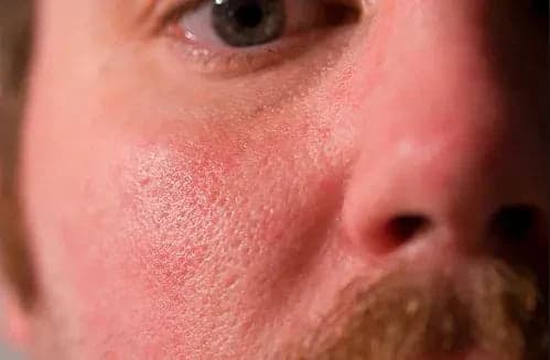 Men's Skincare skin texture image for Prescription Skin