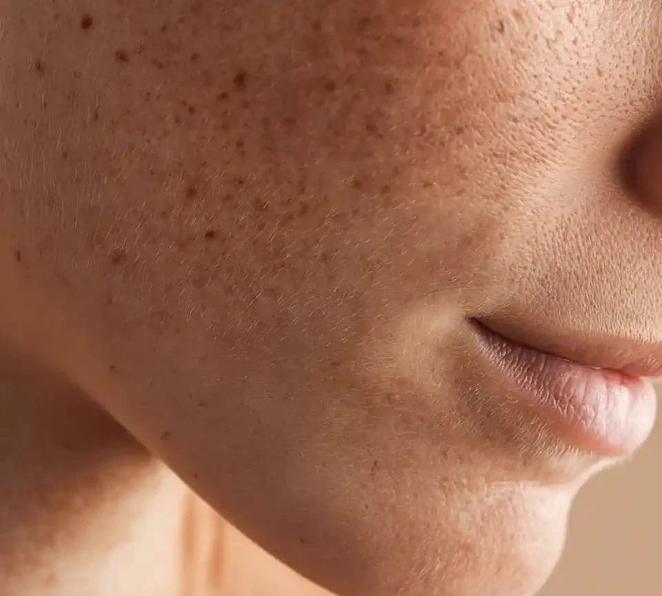 Retinol vs Tretinoin skin texture image for Prescription Skin