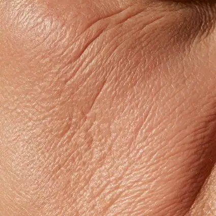 Macro photo of lax cheek and jawline skin with fine crepey lines, illustrating skin tightening concerns