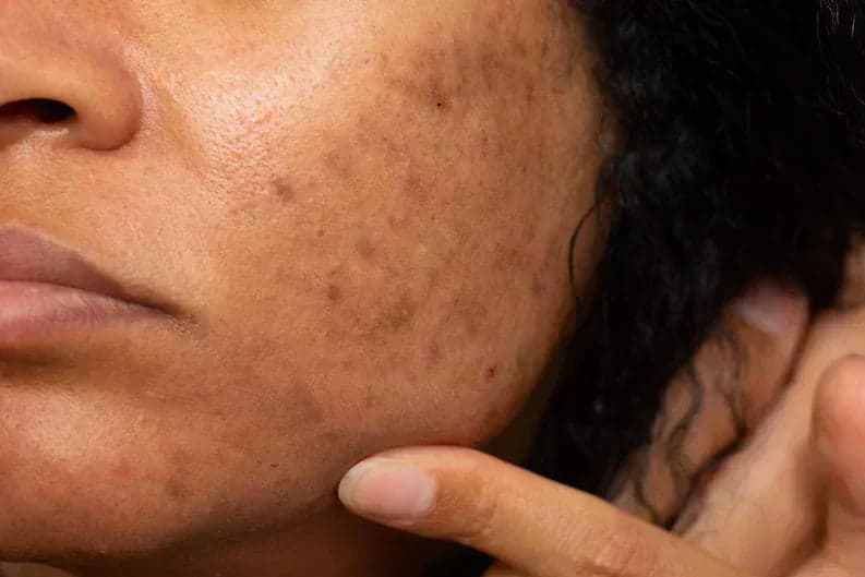 Hydroquinone 2 vs 4 Australia skin texture image for Prescription Skin