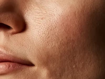 Macro close-up of human skin showing rough skin texture across an uneven, grainy surface