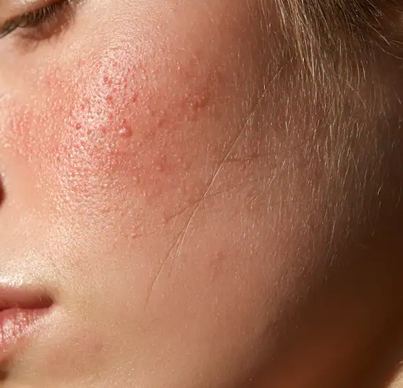 Macro close-up of inflamed forearm skin with red bumps and fine scaling, typical of a rash
