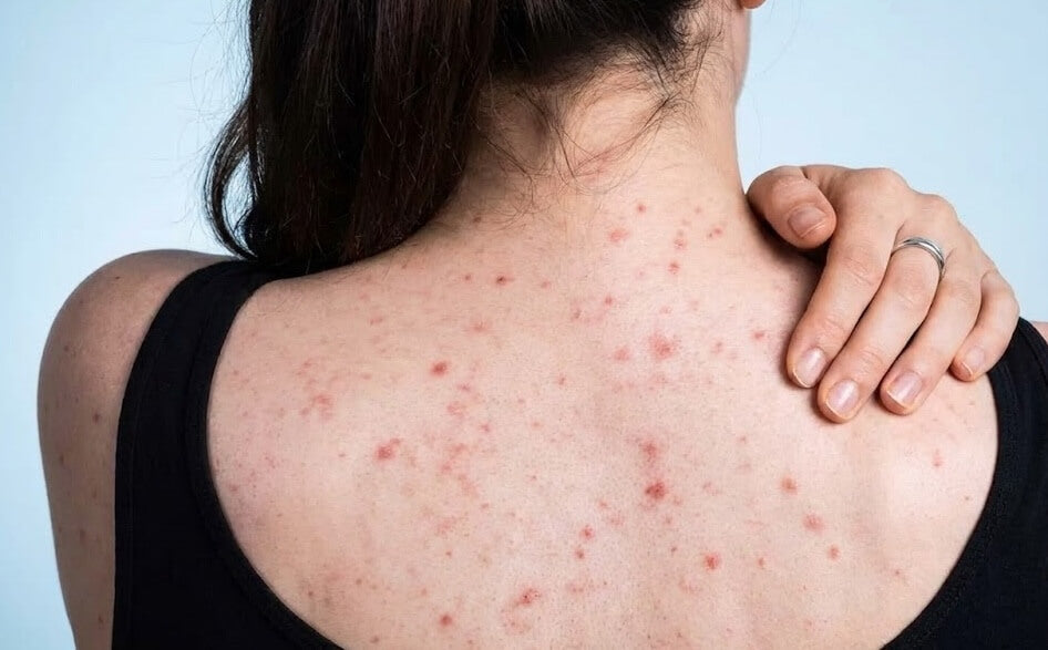 Close up of smooth skin on back after effective bacne scars treatment with prescription skincare