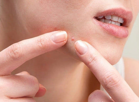 Woman applying a spot treatment cream to a pimple instead of popping it