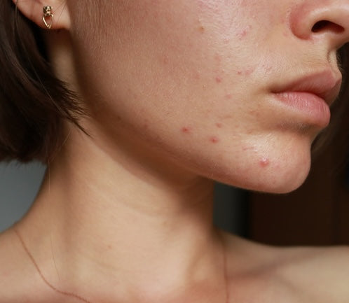 Close-up of purging pimples on the chin during early retinoid treatment