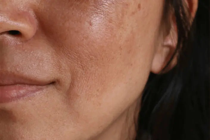 Woman applying skin pigmentation cream to her cheek to treat melasma and dark spots, as part of a prescription routine for hyperpigmentation.