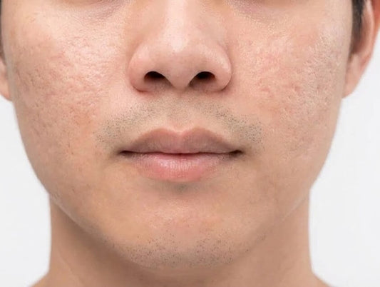 applying a serum to treat acne scarring on her cheek